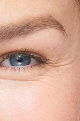 Under-eye wrinkles